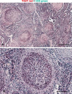 Update in TIGIT Immune-Checkpoint Role in Cancer